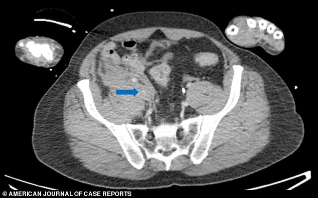 The blue arrow points to a hematoma, or collection of blood, around the iliac vein, which helped control bleeding after the man was impaled by a tube.