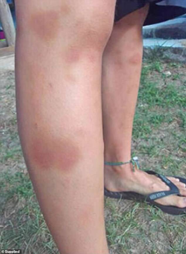 The victim shared a series of bruises she alleges she suffered during the alleged assault with Daily Mail Australia.